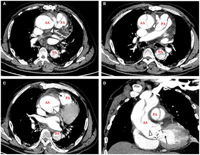 Case Report: Simultaneous Ascending Aortic Dissection and Pulmonary Artery Dissection Combined by Aortopulmonary Fistula After Aortic Valve Replacement